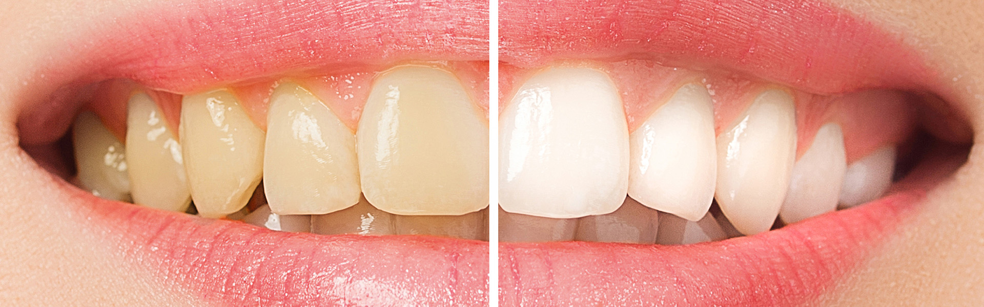 Der Unterschied nach dem Bleaching anhand von zwei lachenden Mündern in der Zahnarztpraxis Emma Klein in Rastede