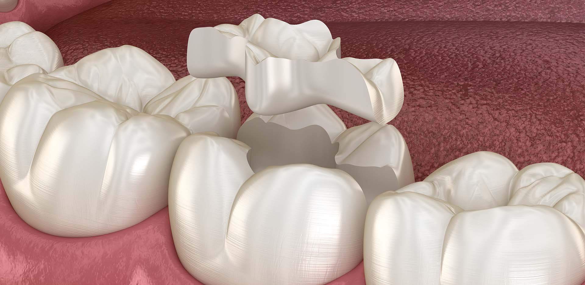 Detailaufnahme von Inlays nach einer Füllungstherapie in der Zahnarztpraxis Emma Klein in Rastede