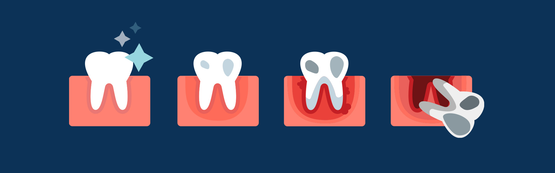 Ohne Parodontosebehandlung in Rastede bei Oldenburg droht der Zahnverlust